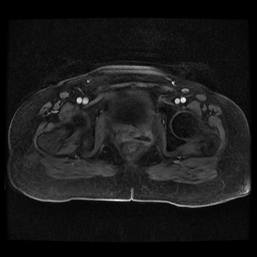 Cervical carcinoma (Radiopaedia 70924-81132 Axial T1 C+ fat sat 123).jpg