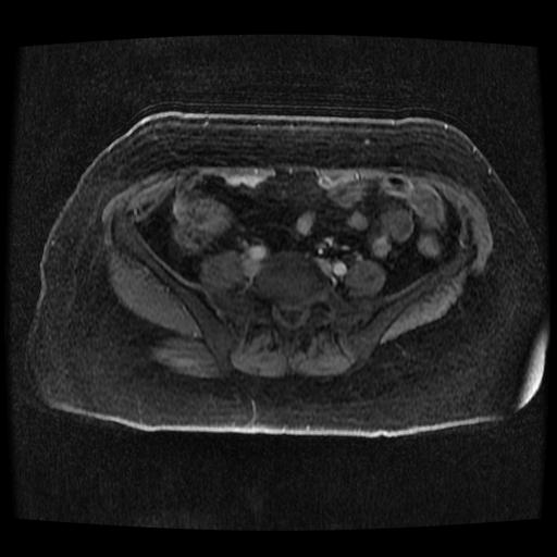 Cervical carcinoma (Radiopaedia 70924-81132 Axial T1 C+ fat sat 168).jpg