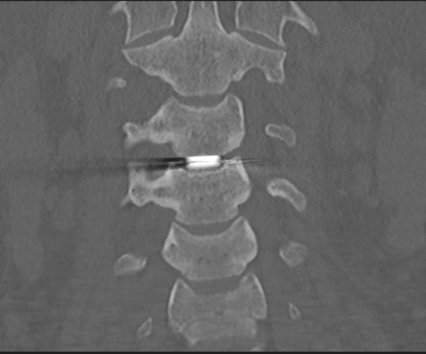 Cervical disc replacement (Radiopaedia 44025-47541 Coronal bone window 19).png