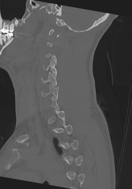 Cervical intercalary bone (Radiopaedia 35211-36748 Sagittal bone window 24).png