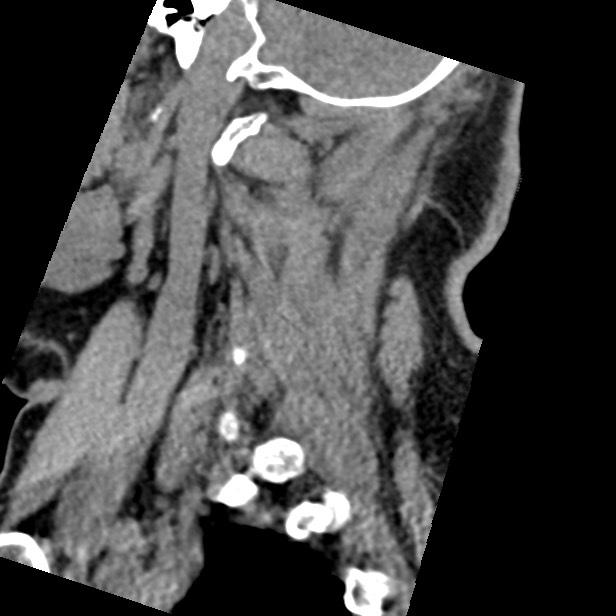 Cervical spinal neurofibroma in a patient with NF1 (Radiopaedia 58344-65464 C 44).jpg