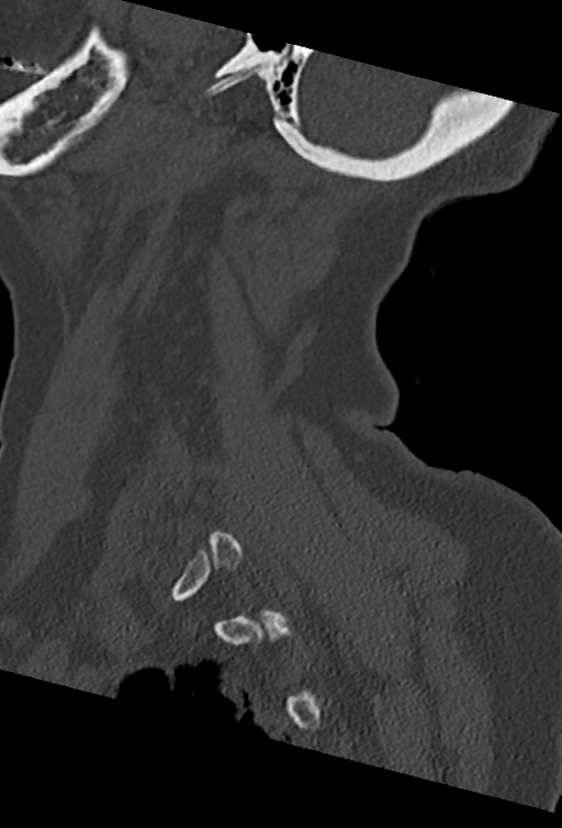Cervical spine ACDF loosening (Radiopaedia 48998-54070 Sagittal bone window 70).png