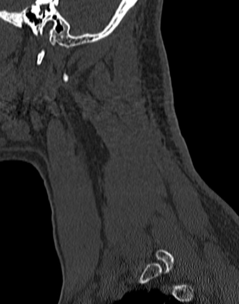 Cervical spondylodiscitis (Radiopaedia 28057-29489 Sagittal bone window 12).jpg