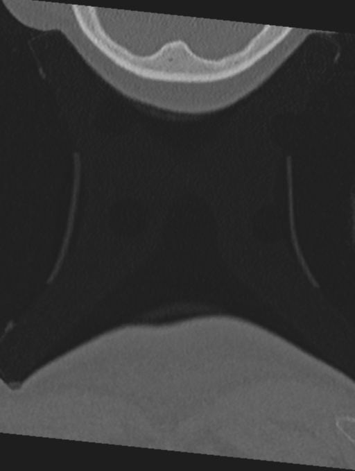 Cervical spondylolysis (Radiopaedia 49616-54811 Coronal bone window 80).png