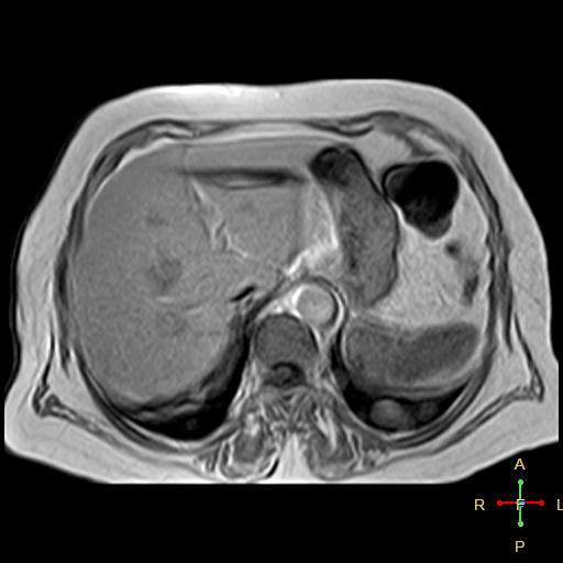 File:Cervical stump squamous cell carcinoma (Radiopaedia 48049-52858 H 13).jpg