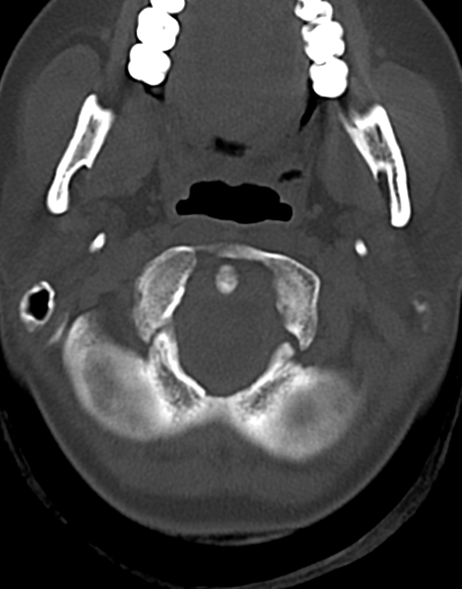 Cervical tuberculous spondylitis (Radiopaedia 39149-41365 Axial bone window 9).png