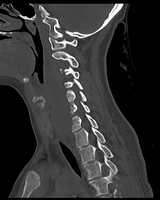 Cervical tuberculous spondylitis (Radiopaedia 39149-41365 Sagittal bone window 28).png