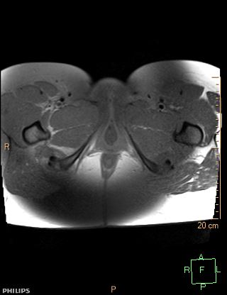 File:Cesarian scar endometriosis (Radiopaedia 68495-78066 Axial T1 fat sat 28).jpg