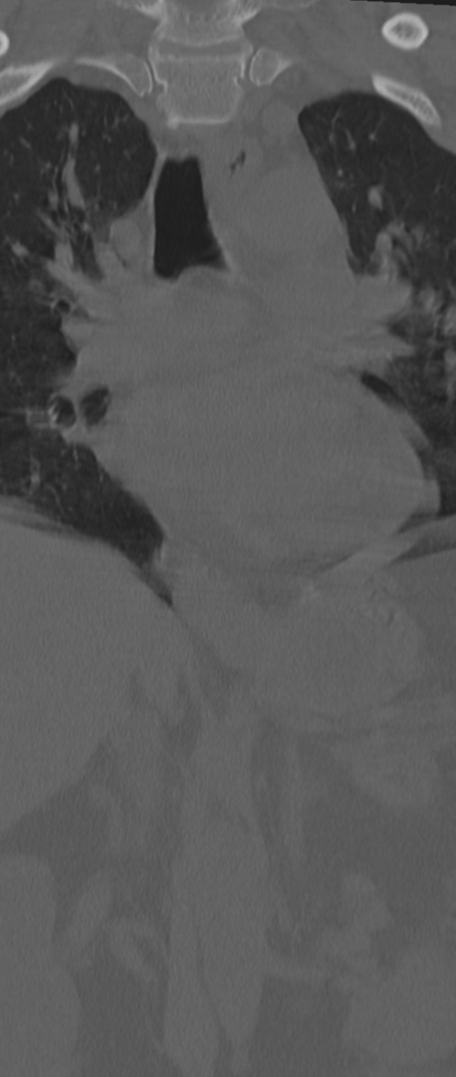 Chance fracture (Radiopaedia 33854-35020 Coronal bone window 20).png