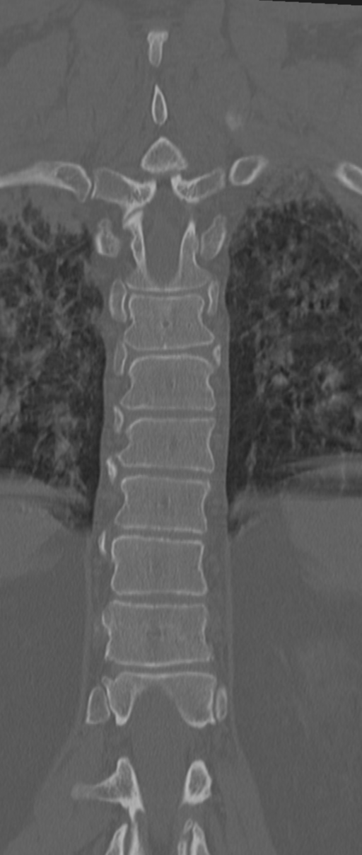 Chance fracture (Radiopaedia 33854-35020 Coronal bone window 57).png