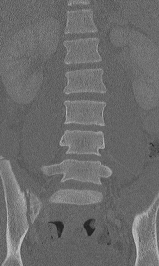 Chance fracture (Radiopaedia 40360-42912 Coronal bone window 28).png