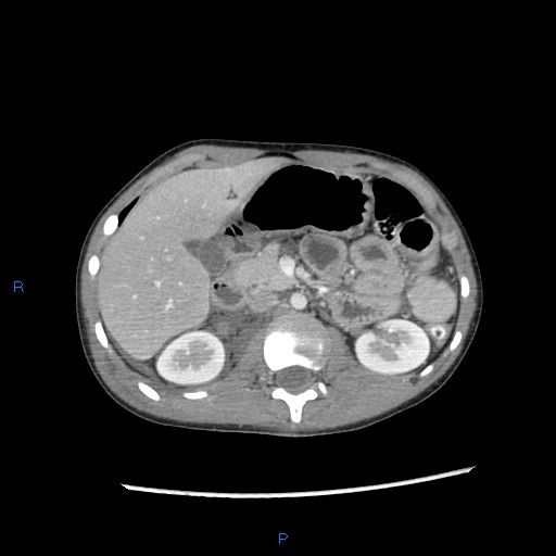 File:Chance fracture with duodenal and pancreatic lacerations (Radiopaedia 43477-46864 A 10).jpg
