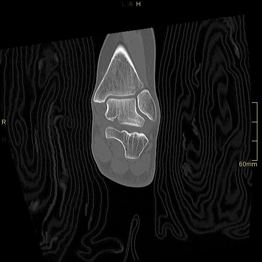Chaput tubercle fracture (Radiopaedia 80319-93956 Coronal non-contrast 39).jpg