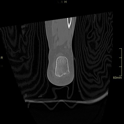 File:Chaput tubercle fracture (Radiopaedia 80319-93956 Coronal non-contrast 54).jpg