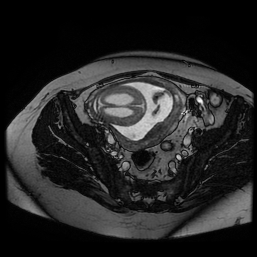 Chiari II malformation - fetal MRI (Radiopaedia 68099-77581 Axial Fiesta 44).jpg
