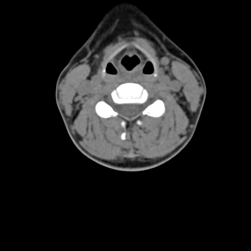 Chiari I malformation and obstructive hydrocephalus (Radiopaedia 41185-43981 D 55).png