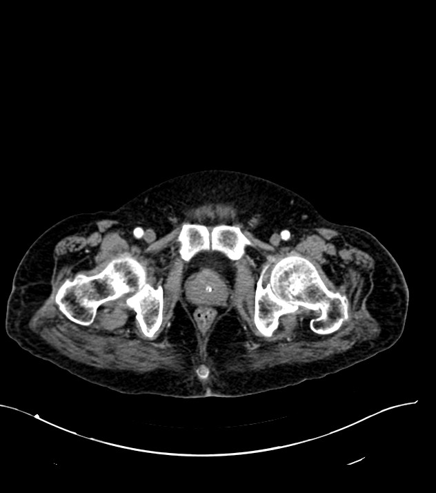 Cholangiocarcinoma with cerebral metastases (Radiopaedia 83519-98629 B 124).jpg