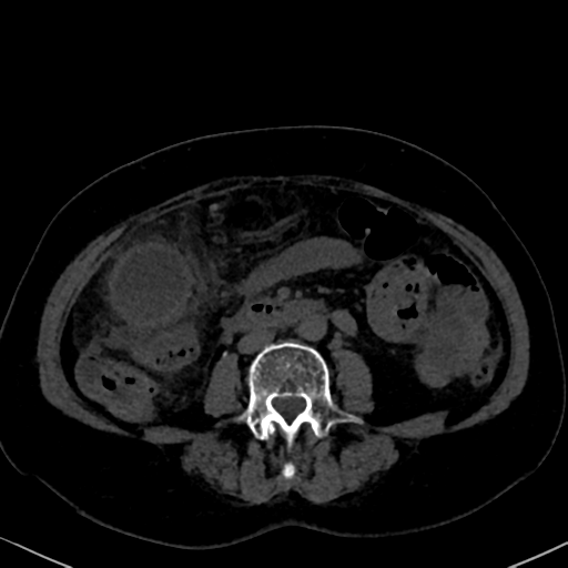File:Cholecystitis - obstructive choledocholitiasis (CT intravenous cholangiography) (Radiopaedia 43966-47479 Axial 142).png