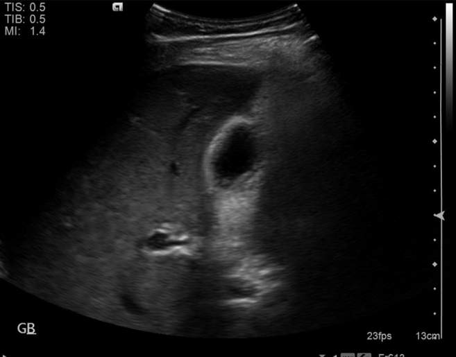 File:Cholecystitis - perforated gallbladder (Radiopaedia 57038-63913 A 15).jpg