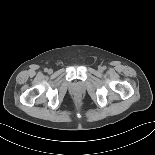 Cholecystitis with focal perforation and hepatic abscess (Radiopaedia 37189-38945 Axial non-contrast 86).png