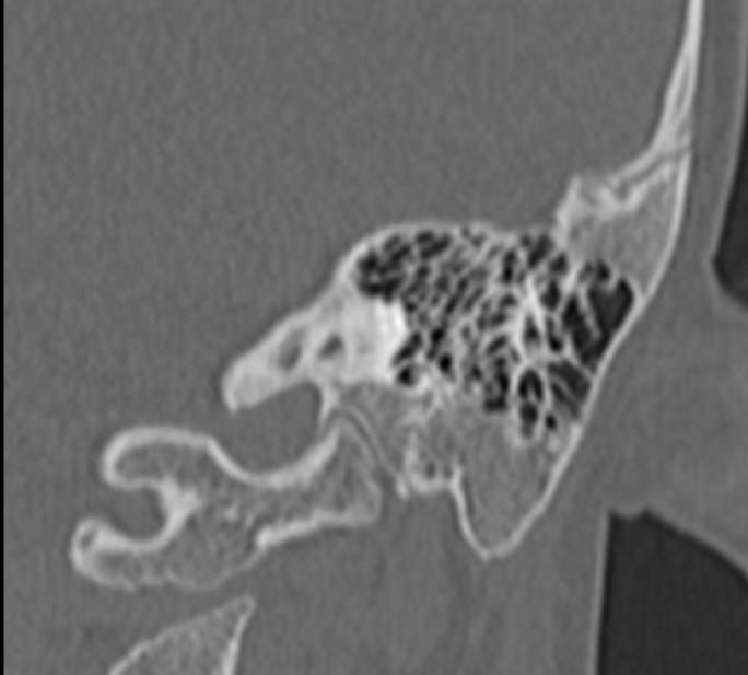 Cholesteatoma (Radiopaedia 73023-83750 Coronal Left ear 59).jpg