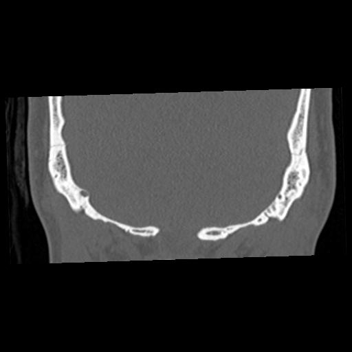 Cholesteatoma (Radiopaedia 84960-100474 Coronal bone window 66).jpg