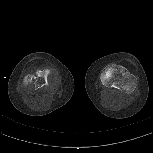 Chondroblastoma (Radiopaedia 62721-71030 Axial bone window 44).jpg