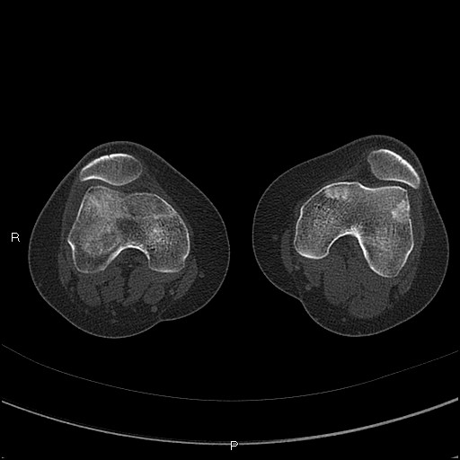 Chondroblastoma (Radiopaedia 62721-71030 Axial bone window 5).jpg