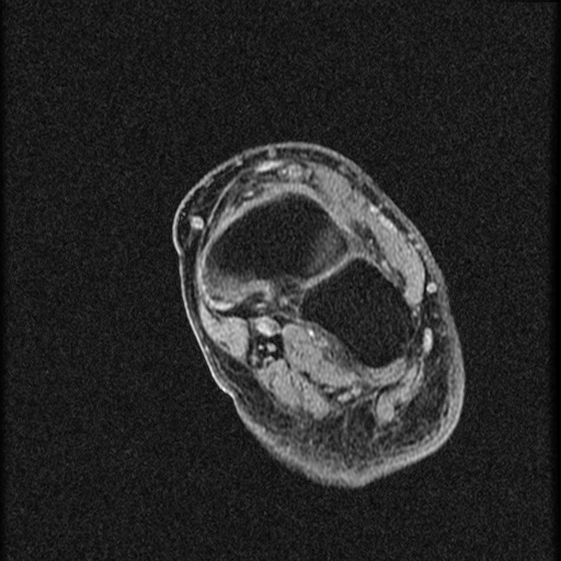File:Chondroblastoma - midfoot (Radiopaedia 64831-73765 F 11).jpg