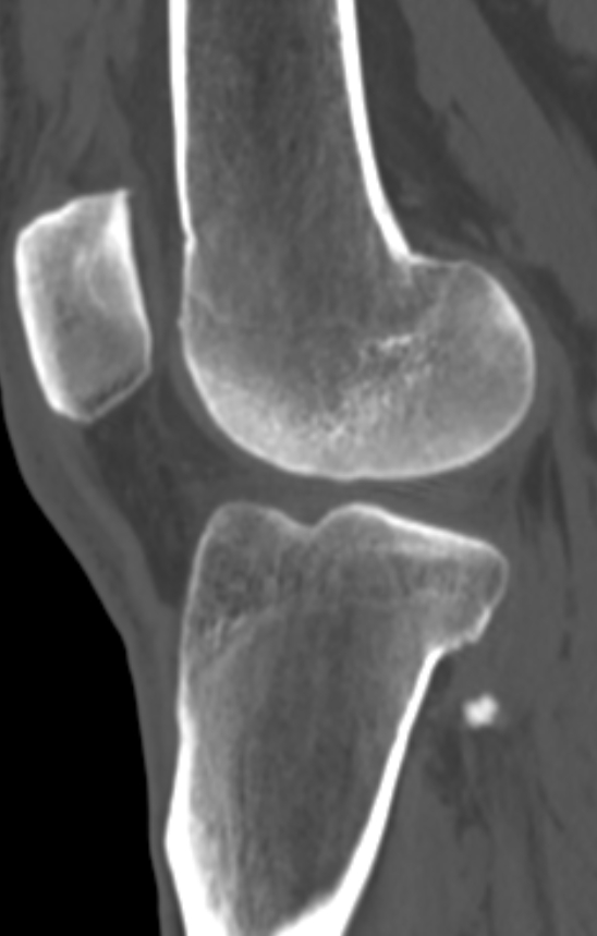 Chondrocalcinosis (Radiopaedia 82862-97173 Sagittal bone window 40).jpg