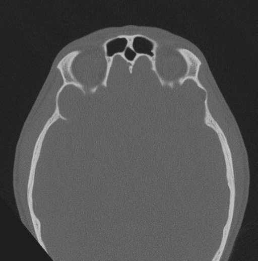 File:Chondrosarcoma (clivus) (Radiopaedia 46895-51425 Axial bone window 11).png