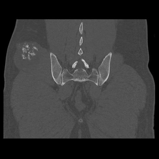 Chondrosarcoma of iliac wing (Radiopaedia 63861-72599 Coronal bone window 91).jpg