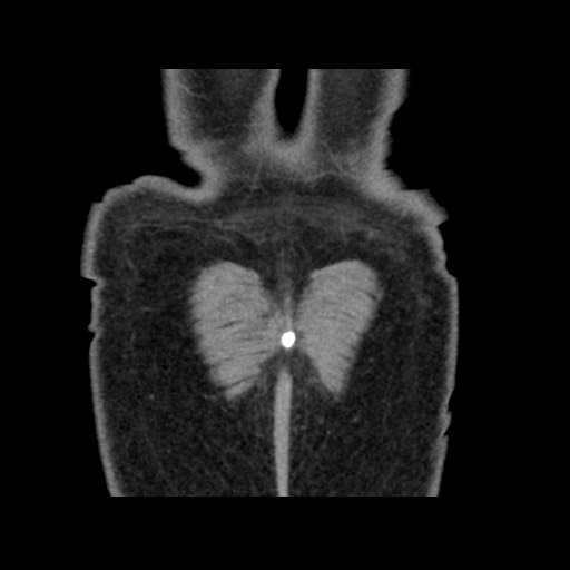 Chondrosarcoma of iliac wing (Radiopaedia 63861-72599 Coronal non-contrast 109).jpg