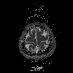 File:Chordoid glioma of third ventricle (Radiopaedia 91612-109340 Axial ADC 26).jpg