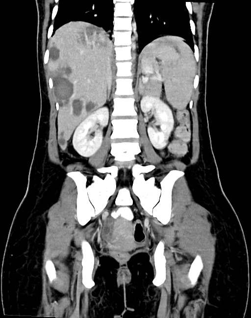 Choriocarcinoma liver metastases (Radiopaedia 74768-85766 B 67).jpg