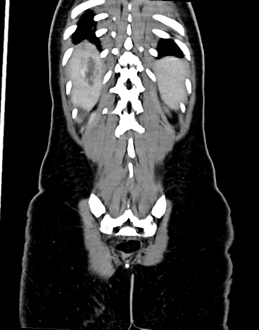 Choriocarcinoma liver metastases (Radiopaedia 74768-85766 B 85).jpg