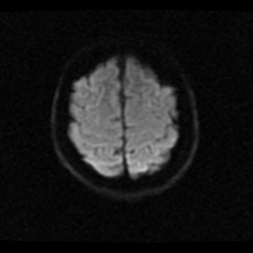 File:Choroid plexus xanthogranuloma (Radiopaedia 17650-17386 DWI 4).jpg
