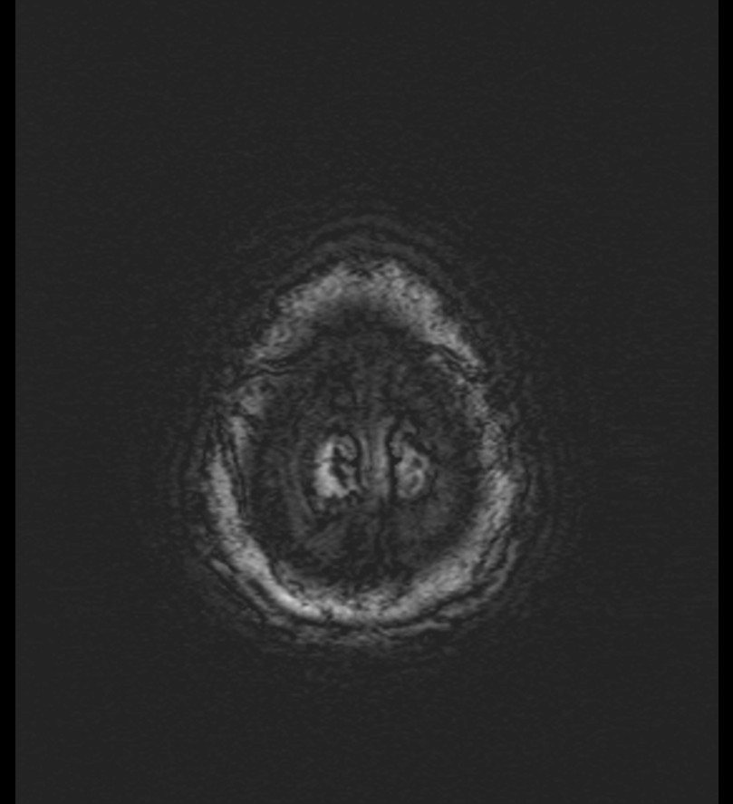 Choroid plexus xanthogranuloma (Radiopaedia 91271-108875 Axial SWI 60).jpg