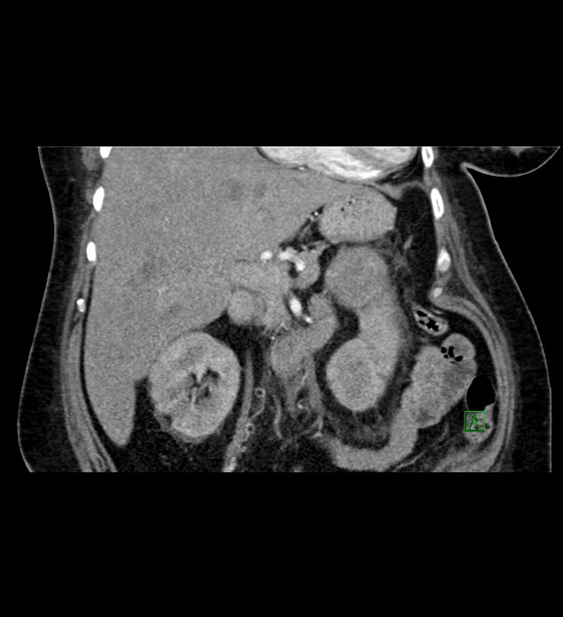 Chromophobe renal cell carcinoma (Radiopaedia 84239-99519 C 41).jpg