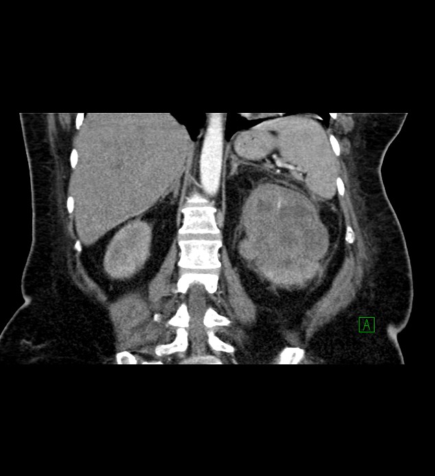 Chromophobe renal cell carcinoma (Radiopaedia 84239-99519 C 61).jpg