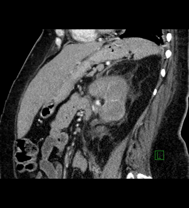 Chromophobe renal cell carcinoma (Radiopaedia 84239-99519 D 47).jpg
