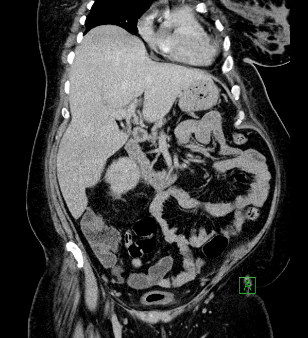 Chromophobe renal cell carcinoma (Radiopaedia 84239-99519 F 35).jpg