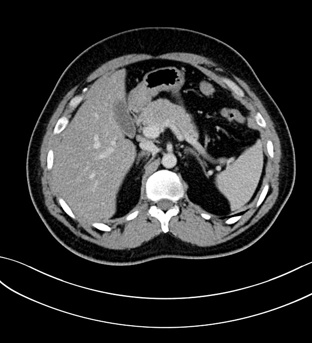 Chromophobe renal cell carcinoma (Radiopaedia 84286-99573 G 19).jpg