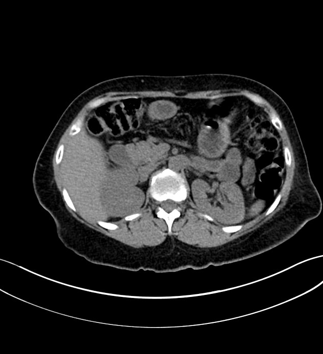 Chromophobe renal cell carcinoma (Radiopaedia 84290-99582 Axial non-contrast 50).jpg