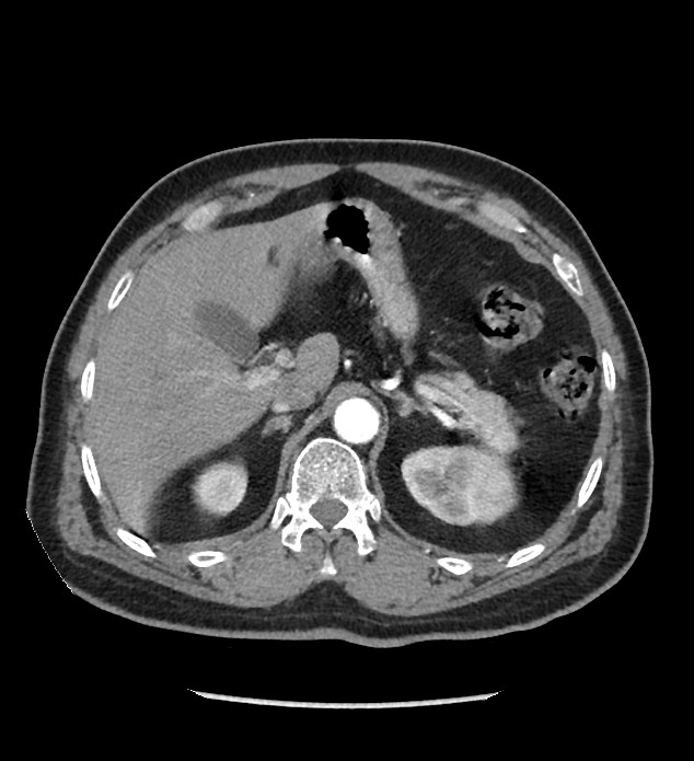 Chromophobe renal cell carcinoma (Radiopaedia 86879-103083 B 38).jpg