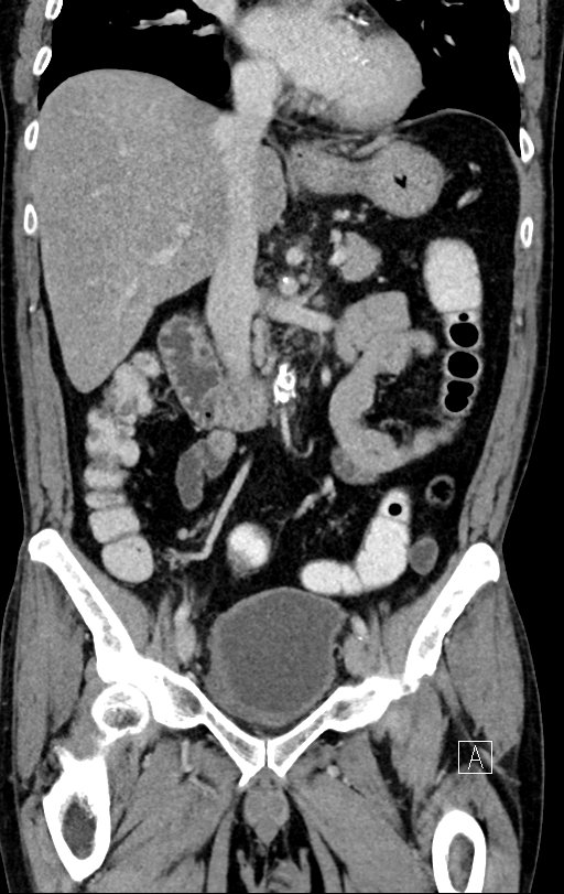 Chronic appendicitis complicated by appendicular abscess, pylephlebitis and liver abscess (Radiopaedia 54483-60700 C 39).jpg