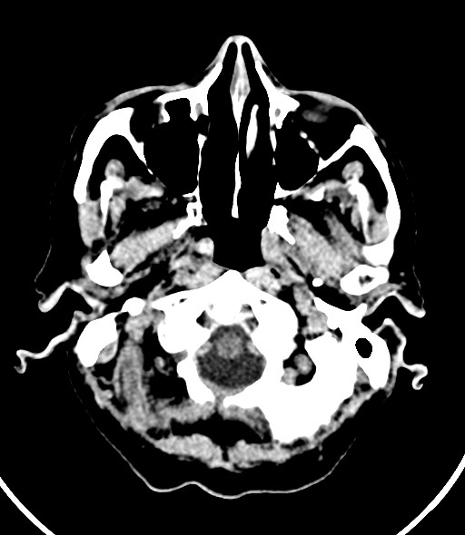 Chronic bilateral subdural hygroma (Radiopaedia 85801-101623 Axial non-contrast 54).jpg
