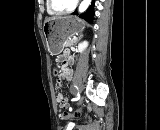 File:Chronic contained rupture of abdominal aortic aneurysm with extensive erosion of the vertebral bodies (Radiopaedia 55450-61901 B 51).jpg
