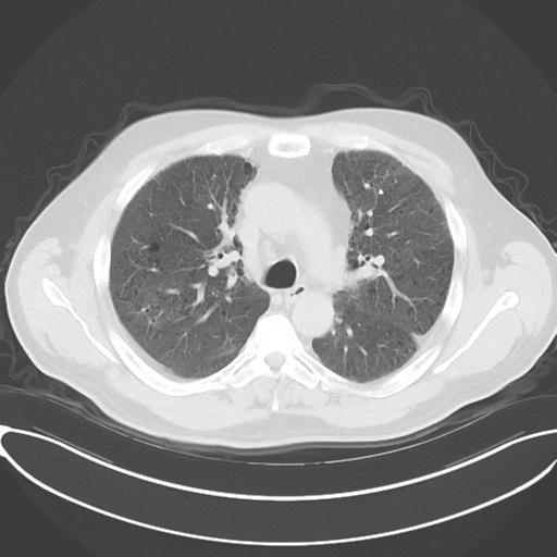 Chronic hypersensitivity pneumonitis (Radiopaedia 48107-52922 Axial lung window 25).png