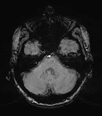 Chronic hypertensive encephalopathy (Radiopaedia 39993-42482 Axial SWI 21).png